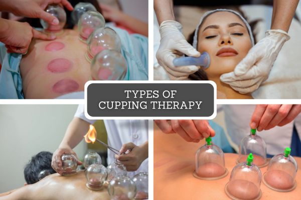 Types of Cupping Therapy